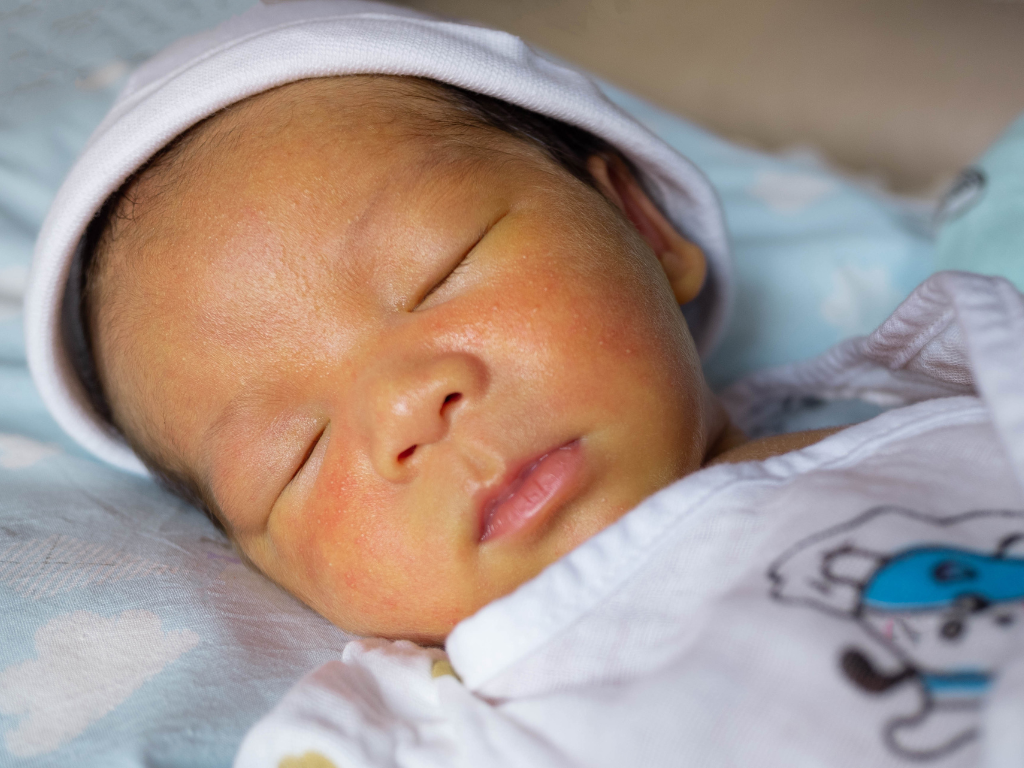 Recém-nascido com coloração amarelada no rosto, indicando sinais de icterícia neonatal.